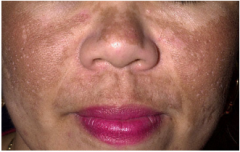 Mask of pregnancy 

Diffuse patchy pigment on face

Pigment in epidermis and/or dermis