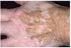 White patches

Complete loss of pigment 

Loss of melanocytes and pigment