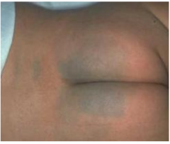 Bluish-gray lumbosacral patch in newborns 

More common in pigmented races 

Resolves in early childhood

Sparse deep dendritic melanocytes