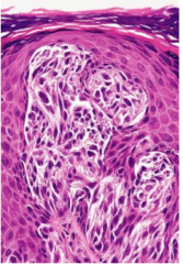 Papular regions of children 

Histologically "benign juvenile melanoma" -- NOT!

Microscopic:  

Epitheliod and spindle cell melanocytes can look atypical 

Nests often vertically oriented