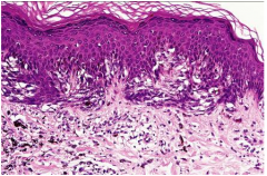 Larger irregular morphology 

Heritable Melanoma Syndrome 

Controversial Diagnosis 

Microscopic: 

Atypical melanocytes 

Nests steam horizontally 

Severely atypical treated as melanoma in situ