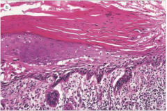 Scaly/hyperkeratotic lesions on sun exposed skin

Considered pre-cancerous, but only about 1% evolve to SCC.  

Microscopic: 

Atypical keratinocytes in lower epidermis 

Underlying solar elastosis (bluish dermis)

Overlying parakeratosi...