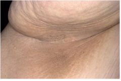 Most common in obesity but rarely associated with internal rumors.  

Clinically velvety brown plaques -- usually in the axillae.