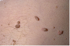 Also known as acrochordons

Skin tags 

More common in obesity involving neck, axillae, and groin areas.  

Can be associated with Acanthosis Nigricans.