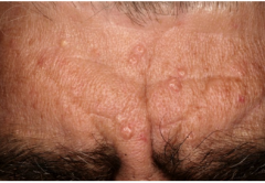 Common in middle and elderly men.  

Umbilicated pale yellowish papules

Benign tumor of sebaceous glands