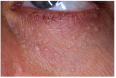 Seen under the eyes of women 

Small skin colored papules

Benign tumor of eccrine sweat glands