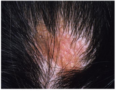 Birthmark lacking hair when on scalp 

Prepubertal may appear smooth yellow/orange 

Adolescent has cobblestone surface

Adult form in prone to basal cell carcinoma.