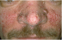 Central facial papules 

One manifestation of Tuberous Sclerosis 

Angiofibromas, histologically.