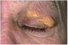 Yellowish plaques on eyelids

Not strongly associated with increased lipids -- other xanthomas associated with increased lipids (associated with lipid disorders)

Foamy histiocytes contain the lipid.