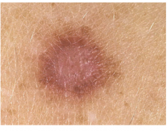 Common in the legs of woemn 

Brownish papule with "dimple sign" 

Benign fibrohistiocytic tumor
