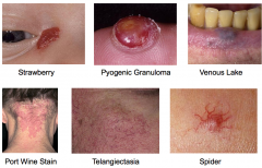 Cherry angiomas most common 

Strawberry angiomas in children often resolve spontaneously 

Pyogenic granuloma is a traumatic variant 

Port wine stains are very common in the form of a "stork bite"  on posterior neck 

Venous lakes occur ...