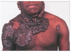 Hypertrophic scars that extend beyond initial injury 

More common in African-American