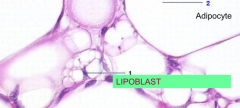 Cells that indicate fatty differentiation in soft tissue tumors; contain cytoplasmic lipid vacuoles that scallop the nucleus
(helpful for identifying poorly differentiated tumors as liposarcomas)