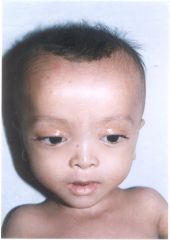 Patients can show craniofacial abnormalities (such as a high forehead, hypoplastic supraorbital ridges, epicanthal folds, midface hypoplasia, and a large fontanel), hepatomegaly (enlarged liver), chondrodysplasia punctata (punctate calcification o...