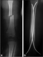   12 yo,  length stable fx (transverse or oblique fx patterns) 
adolescent  wt less < 100 lbs  stable fx
 flex nails  
pain at insertion site near the knee 
 15v/vlg/30R/20A/P/<2
1 yr  