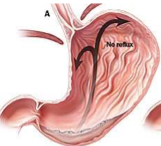 The LES
      (Lower esophageal sphincter) is tight   

The
      peristalsis taken place, allowing activities to take place in the stomach
      only