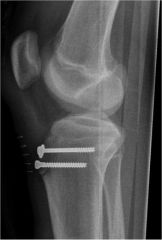 

displaced tibial tuberosity fracture, and the treatment of choice would be open reduction and internal fixation.