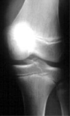 

 A 19-year-old patient is undergoing an arthroscopic treatment of a right knee with suture fixation via transosseous tunnels shown in the video in Figure V. What is the most likely postoperative complication?