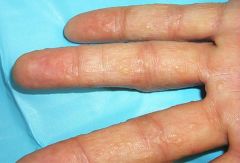 Dyshidrotic eczema is characterized by:
- tense, deep seated vesicles or bullae localized on the palms and soles and often on the lateral aspect of fingers
- acute onset w/ hx of recurrence and remissions (freq episodes for months/yrs)


MANA...