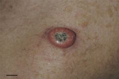 Keratoacanthoma (KA) is a common low-grade (unlikely to metastasize or invade) skin tumour that is believed to originate from the neck of the hair follicle. Many pathologists consider it to be a form of squamous cell carcinoma (SCC). The pathologi...