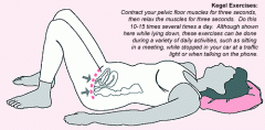 A pelvic floor exercise, more commonly called a Kegel exercise, consists of repeatedly contracting and relaxing the muscles that form part of the pelvic floor (aka Kegel muscles). Exercises are usually done to reduce urinary incontinence after chi...