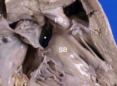 Tetralogy of Fallot. Note septal band and parietal band and the conoventricular septal defect (*).