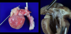 *Persistent Truncus arteriosus.

Left: Probe is in IVC-SVC.
Right: Quadricuspid truncal valve; Subvalvular VSD.