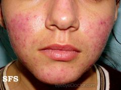 Rosacea is a skin condition marked by redness with plaques or papules (pimples) hence the term acne rosacea. However, rosacea should not be confused with acne vulgaris that is commonly seen in teens as it is a different condition altogether. In fa...