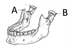 What is the name of structure A on the mandible facial bone?