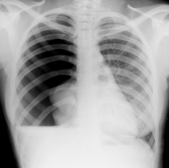 Pneumothorax-the lung has collapsed and fluid is filling the pleural cavity.