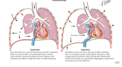 A life-theatening condition in which air accumulates and becomes trapped in the pleural cavity because the injured tissue acts as a one-way valve. Causes complete lung collapse and mediastinal shift toward opposite side. Compromises cardiac output...