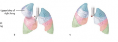 A lobectomy removes a lobe and a pneumonectomy removes an entire lung.