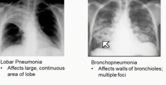 Inflammation of the lung tissue with pus formation (accumulation of white blood cells). There is lobar pneumonia which is a large continuous area whereas bronchopneumonia affects the walls of the bronchioles and has multiple foci.
