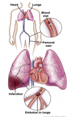 A blockage or blood clot of the pulmonary artery which causes difficulty breathing, tachycardia, chest pain, and cyanosis. This is commonly a complication of Deep Vein Thrombosis and is treated with anticoagulants or IVC filter.