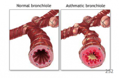 A chronic disease that results in narrowing of the airways due to inflammation or bronchoconstriction. This is a functional not structural problem therefore is reversible with sympathomimetics (mimics epinephrine).