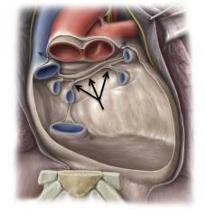 A reflection of the parietal pericardium which separates the outflow and inflow vessels.