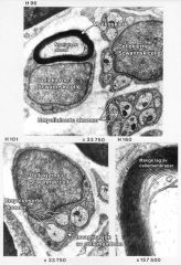 Myeliniserte - omgitt av flere lag cellemembraner fra en Swannsk celle som har tvunnet seg rundt aksonet

Umyeliniserte - Begravet i innbuktning av cellemembranen til Swannsk celle