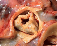 Condition in which the opening of the valve is narrowed due to calcifications or scarring on the valve leaflets
