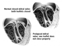 A condition in which one or both leaflets of the mitral valve prolapse (evert) into the left atrium, allowing blood to regurgitate back into the left atrium during systole. This causes a midsystolic clicking sound