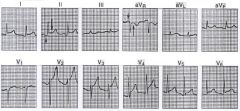 upsloping ST elevation in II, III, aVF, V2-V6


 


small downward PR deviation- in all except aVR (in PRecordial leads)


 


(pericarditiS- small p & a big S)