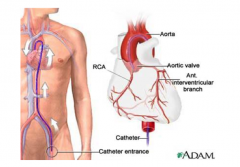 A catheter threaded through the femoral artery inserting radiopaque dye into the aorta and visualized as it travels through the coronary arteries.