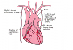 A coronary artery bypass graft can be done using a saphenous vein harvested from the leg or attached directly from the mammary artery