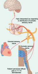 Noxious stimuli from an internal organ are perceived as superficial pain because the afferent fibers carrying the visceral afferent nerves also carry the dermatome nerves. "Cardiac pain" therefore arises from the T1-T4 spinal levels