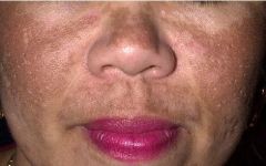 • “Mask of pregnancy”
• Diffuse patchy pigment on face.
• Pigment in epidermis and/or dermis.