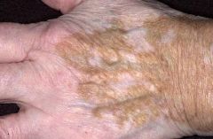 • White patches
• Complete loss of pigment.
• Loss of melanocytes and pigment.