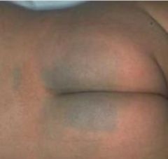 • Bluish-gray lumbosacral patch in newborns.
• More common in pigmented races.
• Resolves in early childhood.
• Sparse deep dendritic melanocytes.