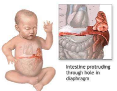 Congential diaphragmatic hernia (CDH) is a congential malformation (birth defect) of the diaphragm

Usually an opening in the diaphragm 