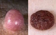 • Papular lesions
• Light or dark
• Nests of melanocytes within
the dermis