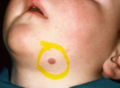 • Papular lesions of children
• Historically “benign juvenile
melanoma” – avoid this term!
• Epithelioid and spindle cell
melanocytes can look atypical
• Nests often vertically oriented