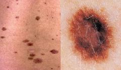 • Larger irregular morphology
• Heritable Melanoma Syndrome
• Controversial Diagnosis
• Atypical melanocytes
• Nests stream horizontally
• Severely atypical treated as
melanoma in situ